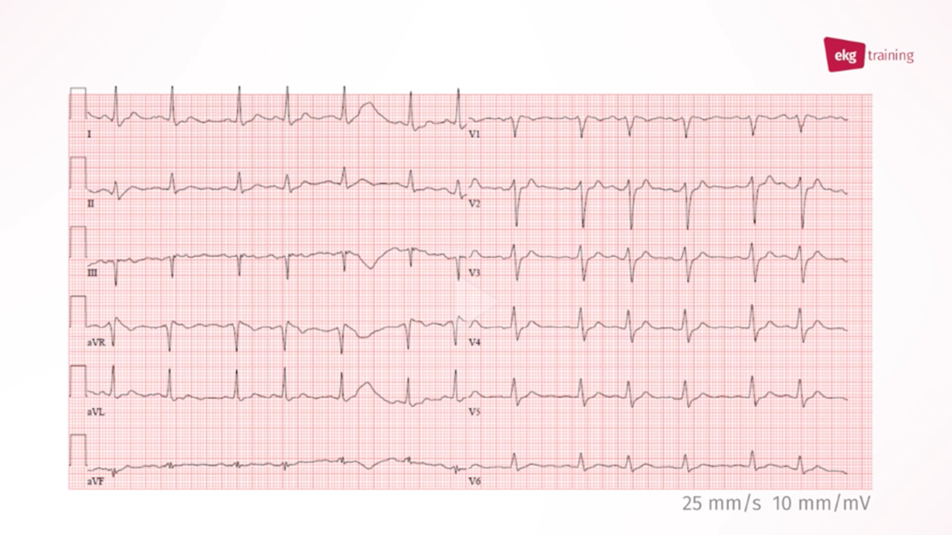 ekg-diagnose-bei-zustand-nach-reanimation-ekg-training